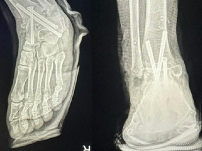 왼발 수술인데 오른발 절단…환자 “양다리 못써, 절망”